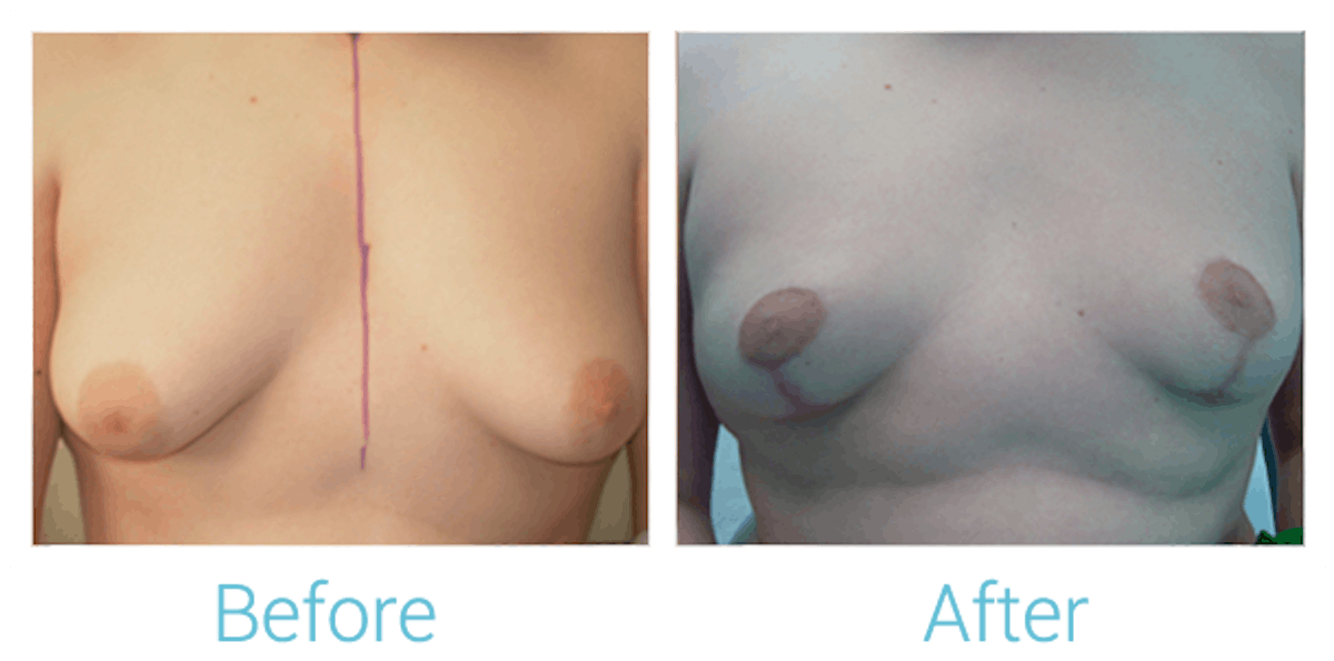 Breast Lift Before & After Gallery - Patient 58151867 - Image 1