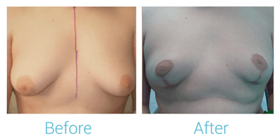 Breast Lift Before & After Gallery - Patient 58151867 - Image 1