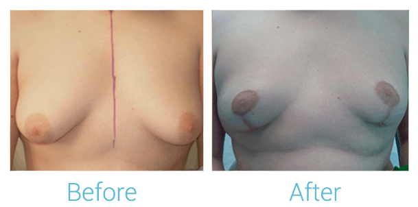 Breast Lift Gallery - Patient 58151867 - Image 1