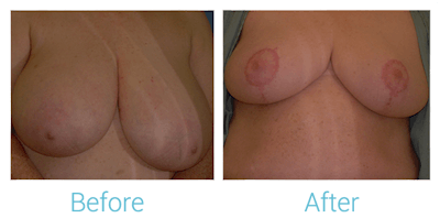 Breast Lift Before & After Gallery - Patient 58151868 - Image 1