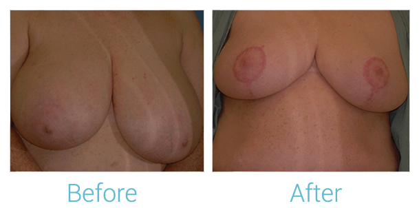 Breast Lift Before & After Gallery - Patient 58151868 - Image 1