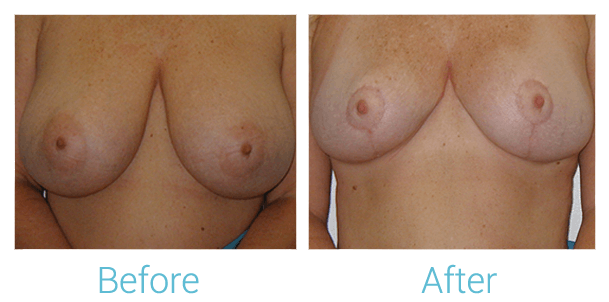 Breast Lift Before & After Gallery - Patient 58151869 - Image 1