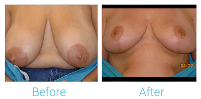 Breast Lift Before & After Gallery - Patient 58151870 - Image 1