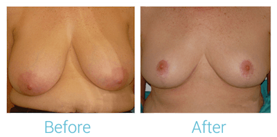 Breast Lift Before & After Gallery - Patient 58151871 - Image 1