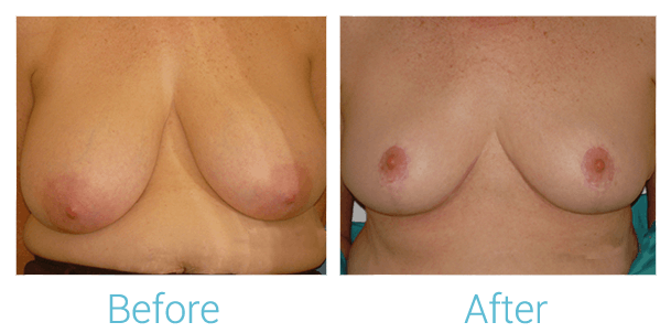 Breast Lift Before & After Gallery - Patient 58151871 - Image 1