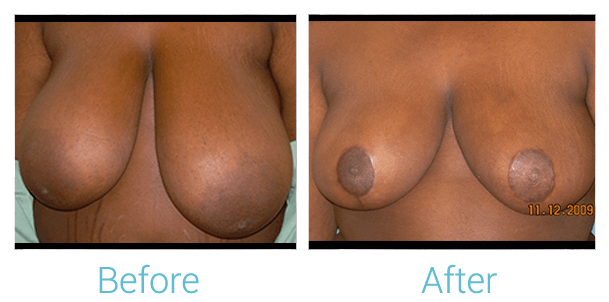 Breast Lift results in Baltimore with Dr. Birely