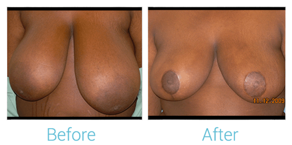 Breast Lift Before & After Gallery - Patient 58151872 - Image 1