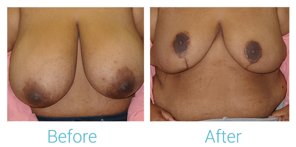 Breast Lift Before & After Gallery - Patient 58151873 - Image 1