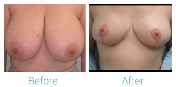 Breast Lift Before & After Gallery - Patient 58151874 - Image 1