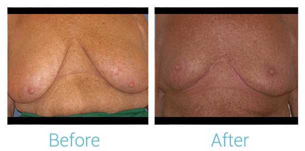 Breast Lift Before & After Gallery - Patient 58151875 - Image 1