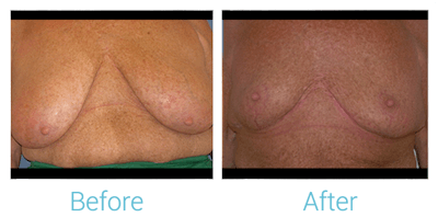 Breast Lift Before & After Gallery - Patient 58151875 - Image 1