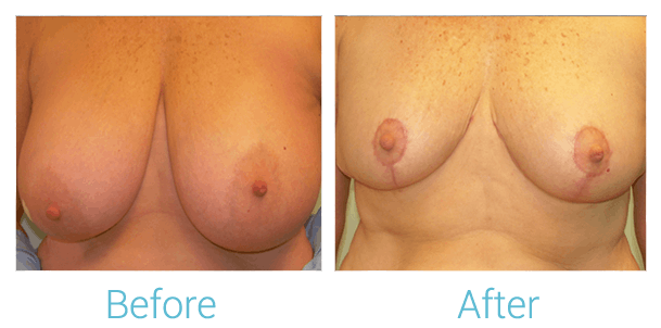 Breast Lift Before & After Gallery - Patient 58151876 - Image 1