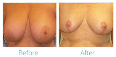 Breast Lift Gallery - Patient 58151876 - Image 1