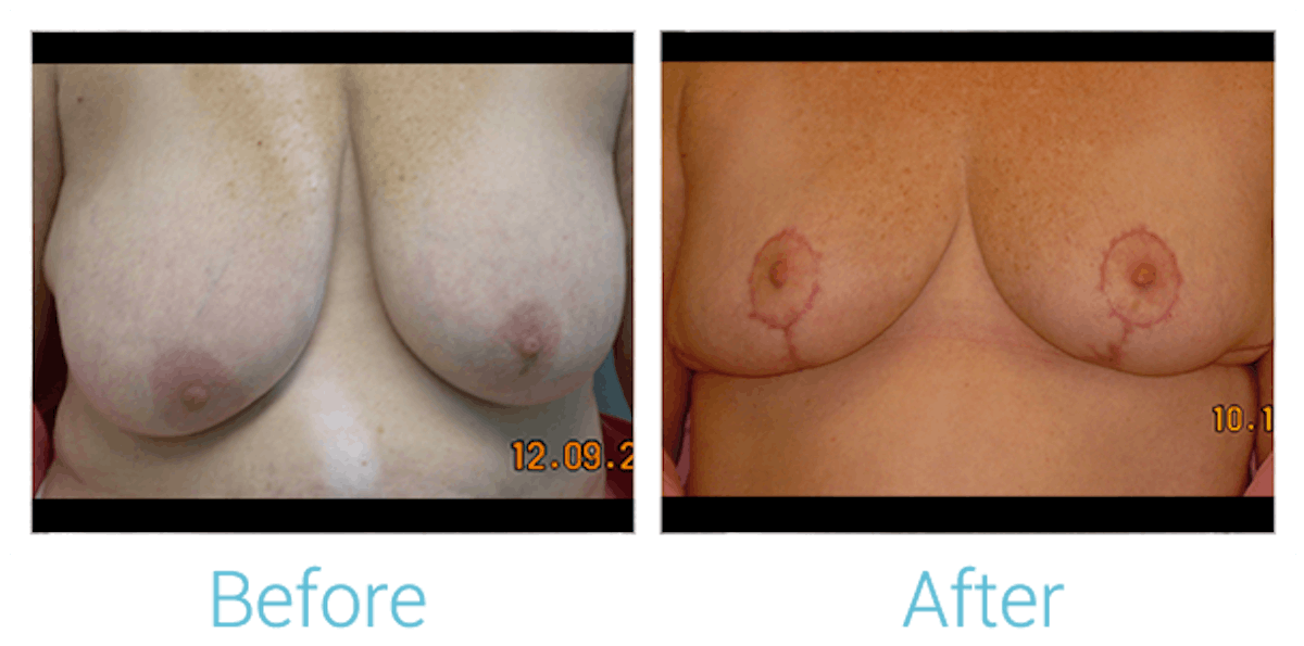 Breast Lift Before & After Gallery - Patient 58151877 - Image 1