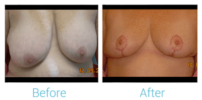 Breast Lift Before & After Gallery - Patient 58151877 - Image 1