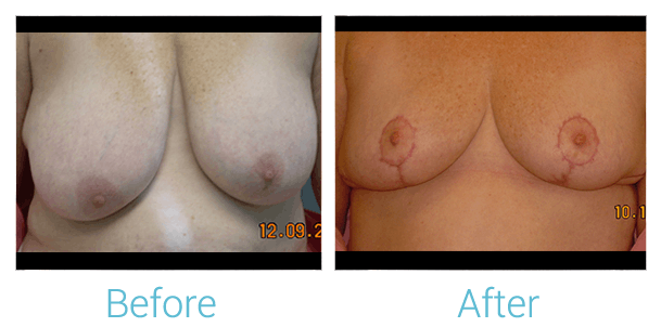Breast Lift Before & After Gallery - Patient 58151877 - Image 1