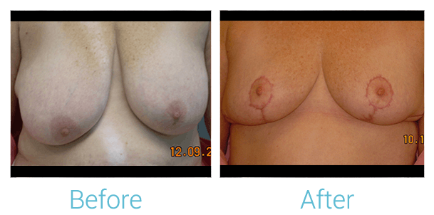 Breast Lift Gallery - Patient 58151877 - Image 1