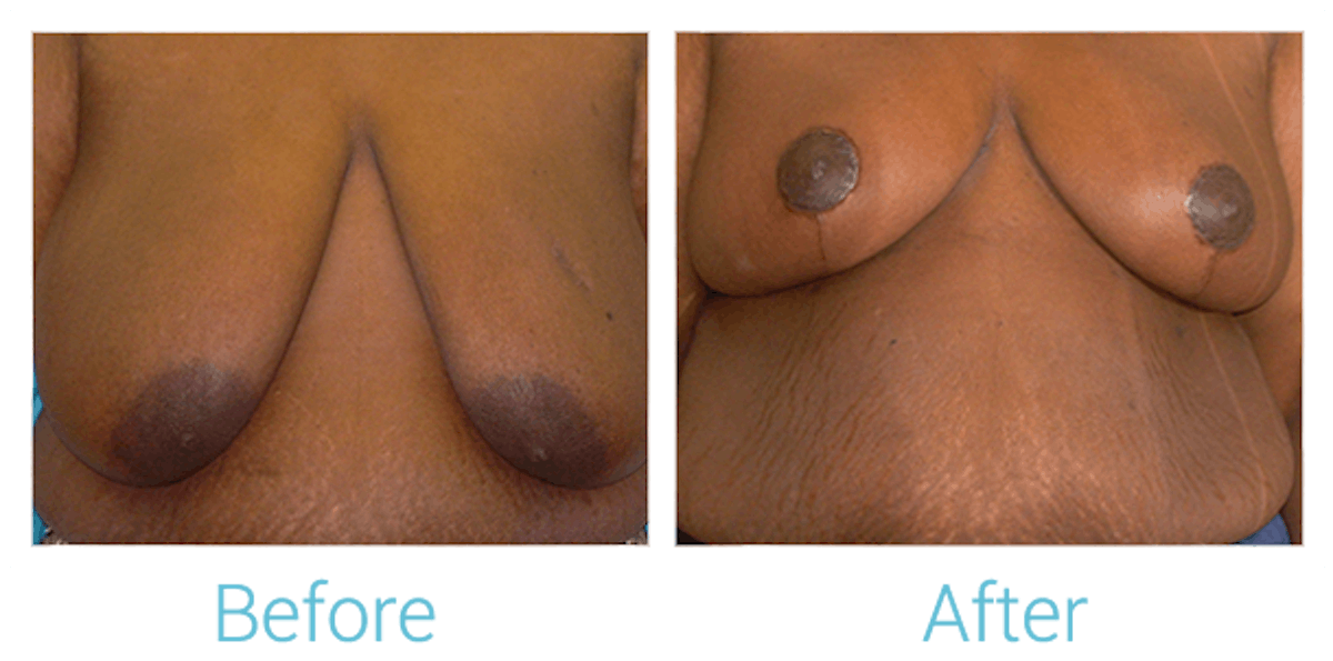 Breast Lift Before & After Gallery - Patient 58151878 - Image 1