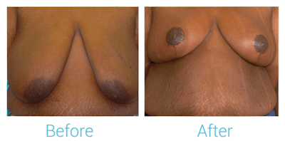 Breast Lift Before & After Gallery - Patient 58151878 - Image 1