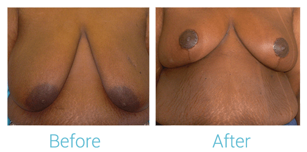 Breast Lift Before & After Gallery - Patient 58151878 - Image 1