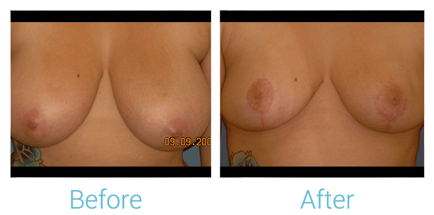 Breast Lift Gallery - Patient 58151879 - Image 1