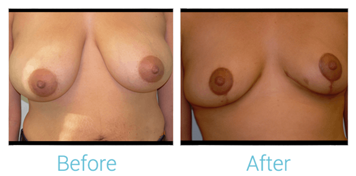 Breast Lift Before & After Gallery - Patient 58151880 - Image 1