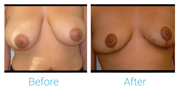 Breast Lift Gallery - Patient 58151880 - Image 1
