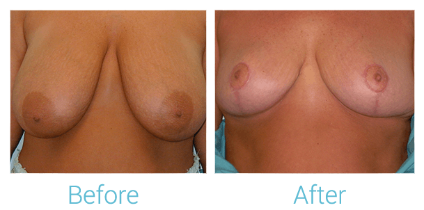 Breast Lift Before & After Gallery - Patient 58151881 - Image 1
