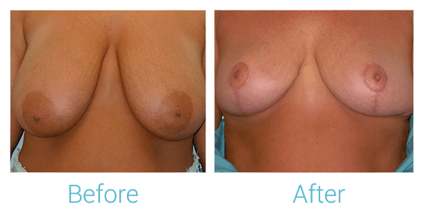 Breast Lift Gallery - Patient 58151881 - Image 1