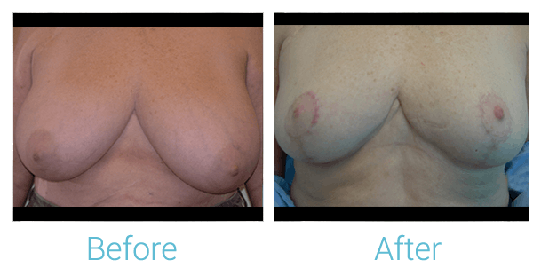 Breast Lift Before & After Gallery - Patient 58151882 - Image 1