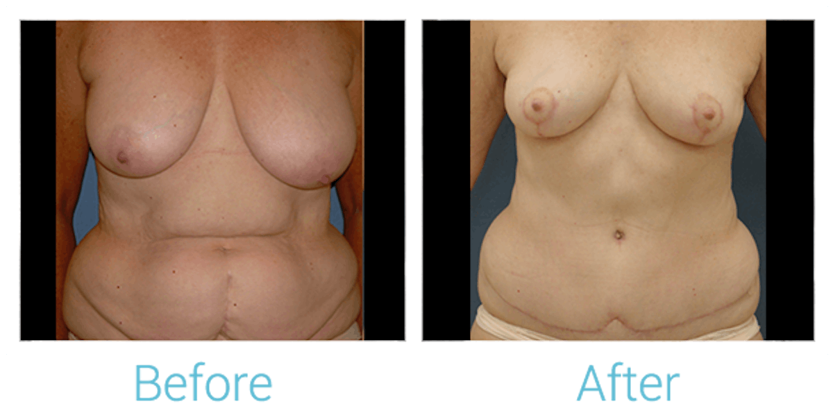 Mommy Makeover Before & After Gallery - Patient 58152028 - Image 1