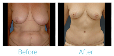 Mommy Makeover Before & After Gallery - Patient 58152028 - Image 1