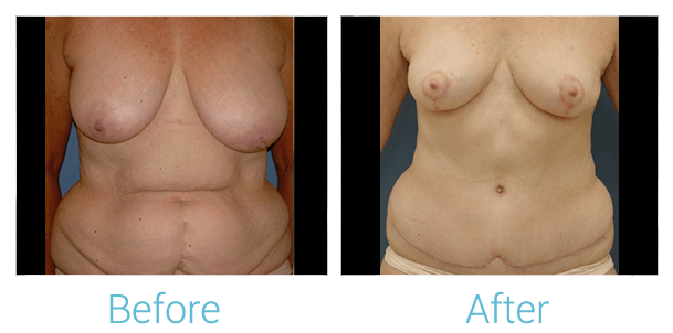 Mommy Makeover Before & After Gallery - Patient 58152028 - Image 1