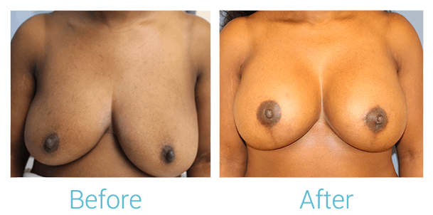 Breast Lift Before & After Gallery - Patient 58151884 - Image 1