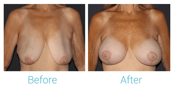Breast Lift Gallery - Patient 58151885 - Image 1
