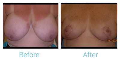 Breast Reduction Gallery - Patient 58151902 - Image 1