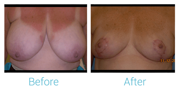 Breast Reduction Before & After Gallery - Patient 58151902 - Image 1