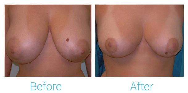 Breast Reduction