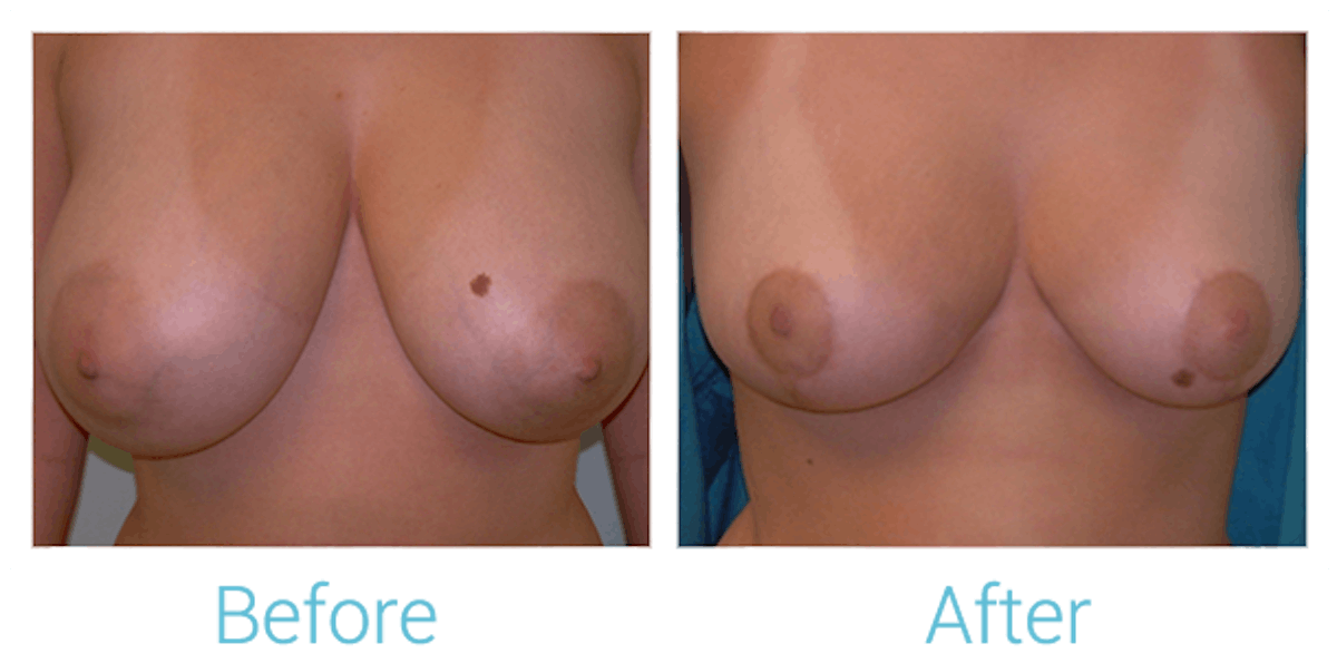 Breast Reduction Before & After Gallery - Patient 58151903 - Image 1