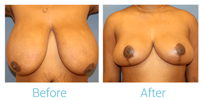 Breast Reduction Before & After Gallery - Patient 58151916 - Image 1