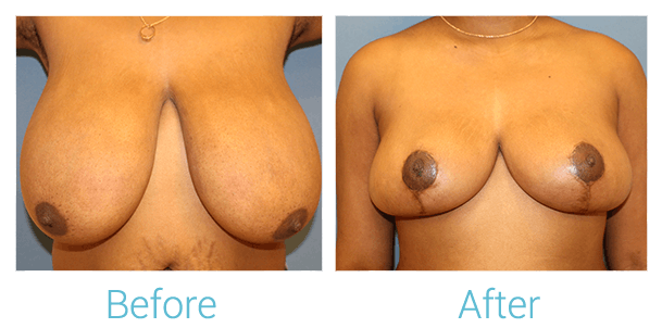 Breast Reduction Gallery - Patient 58151916 - Image 1