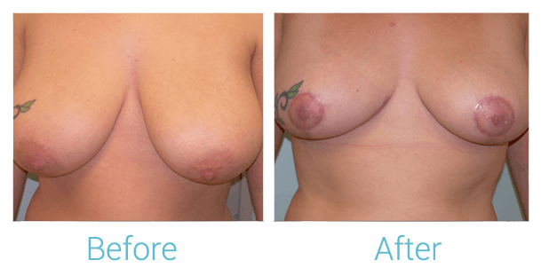 Breast Reduction Before & After Gallery - Patient 58151909 - Image 1