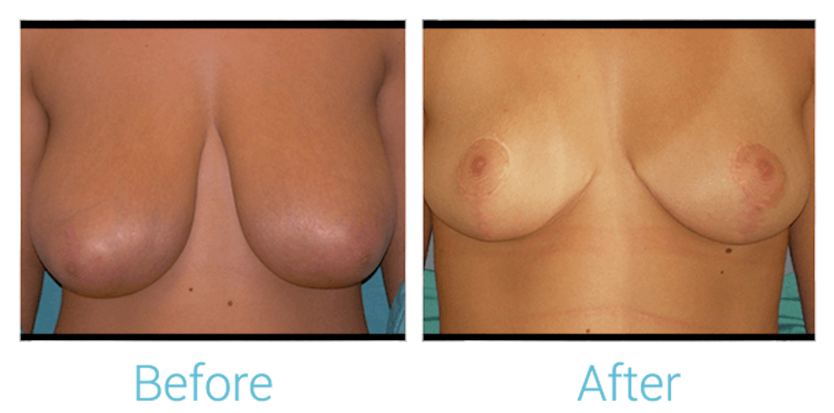 Breast Reduction Before & After Gallery - Patient 58151915 - Image 1