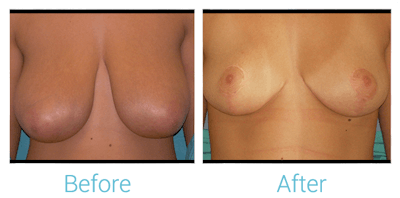 Breast Reduction Before & After Gallery - Patient 58151915 - Image 1