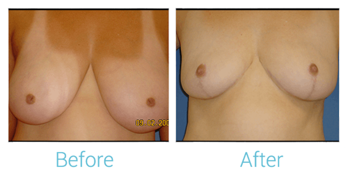 Breast Reduction Before & After Gallery - Patient 58151910 - Image 1