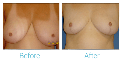 Breast Reduction Before & After Gallery - Patient 58151910 - Image 1
