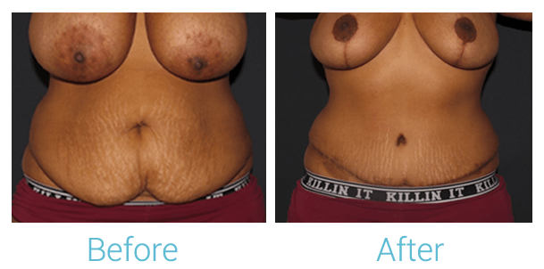 Mommy Makeover