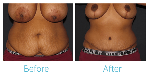 Breast Reduction Before & After Gallery - Patient 58151917 - Image 1