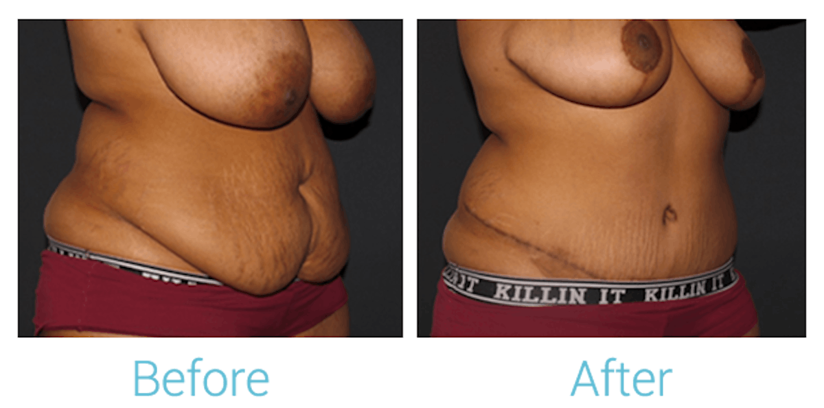 Breast Reduction Before & After Gallery - Patient 58151917 - Image 2