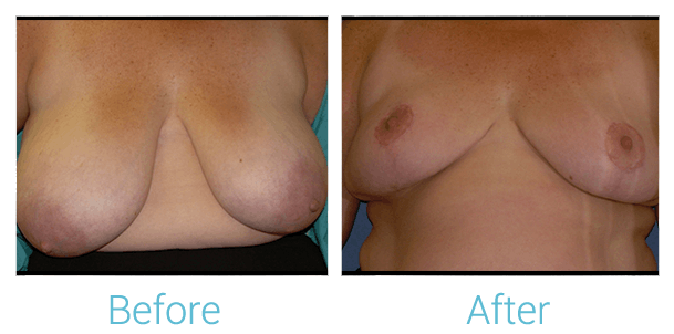 Breast Reduction Gallery - Patient 58151911 - Image 1